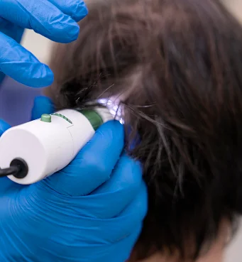 Exosome Hair Therapy